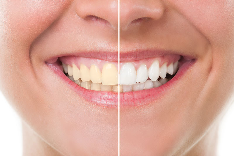 Teeth Whitening in Santa Monica